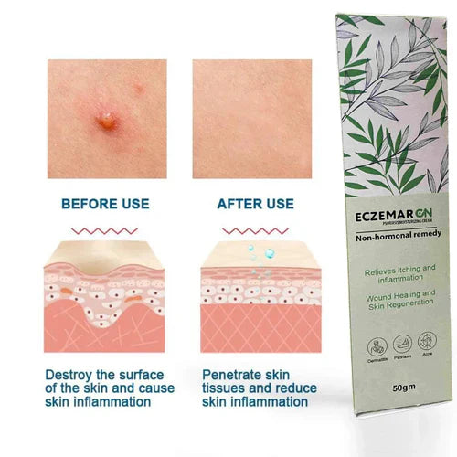 Ecze+ Anti Fungal Spray (Buy 1 Get 1 Freeš„š„)