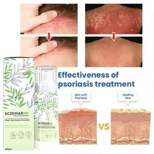 Ecze+ Anti Fungal Spray (Buy 1 Get 1 Freeš„š„)